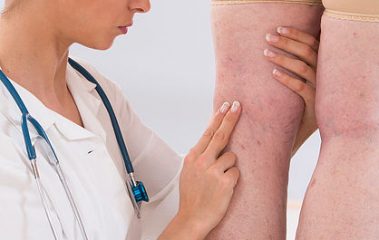 38595067 - doctor showing varicose veins from an elderly woman